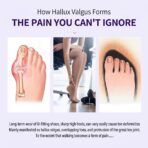 NEW Hallux Valgus Bunion Corrector for Women and Men Orthopedic Bunion Toe Straightener Adjustable Bunion Splint(JD025T) - Image 10